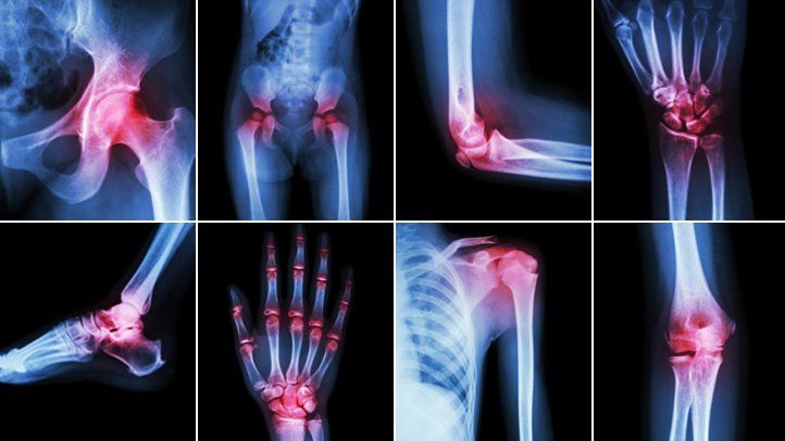 Arthritis Advance Screening
