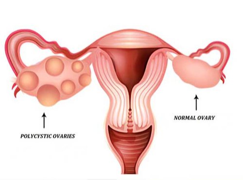 Polycystic Ovaries Disease